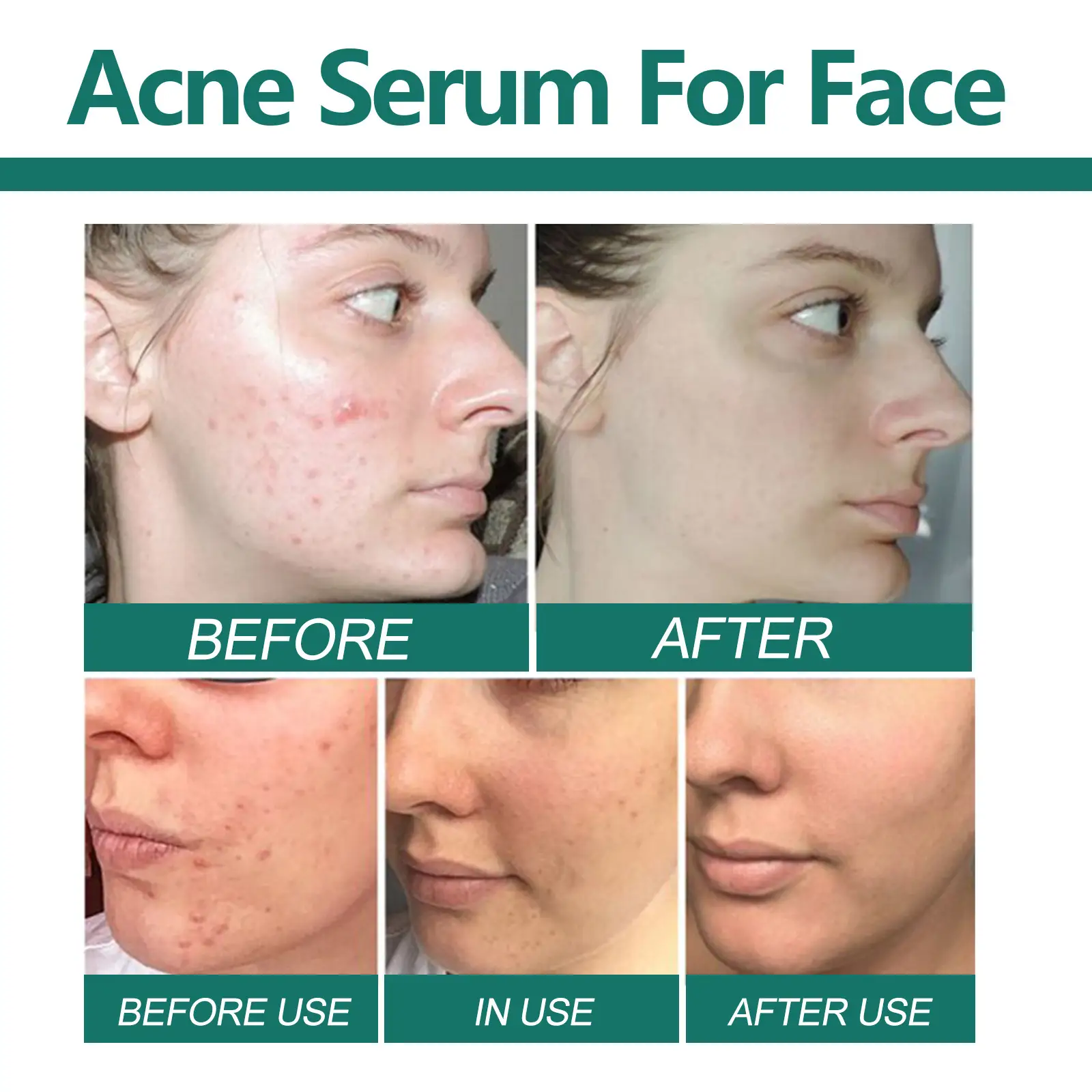 Smallpox Diluting Delicate Pores Replenishment Repair