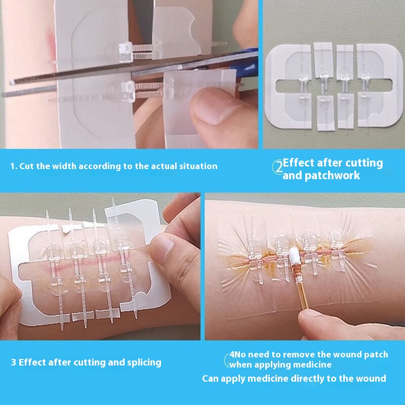 Title 9, 10-button Paste Tensioner Post-operation Suture...