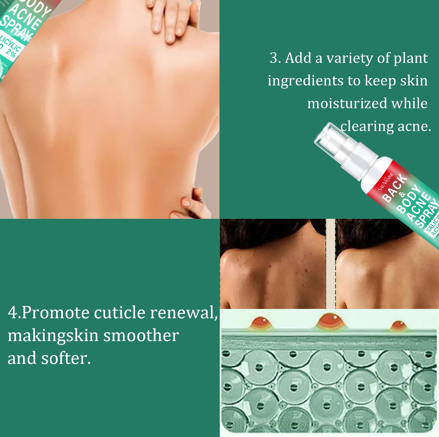 Body Back Acne Spray Refreshing Moisturizing Chest Acne Spray