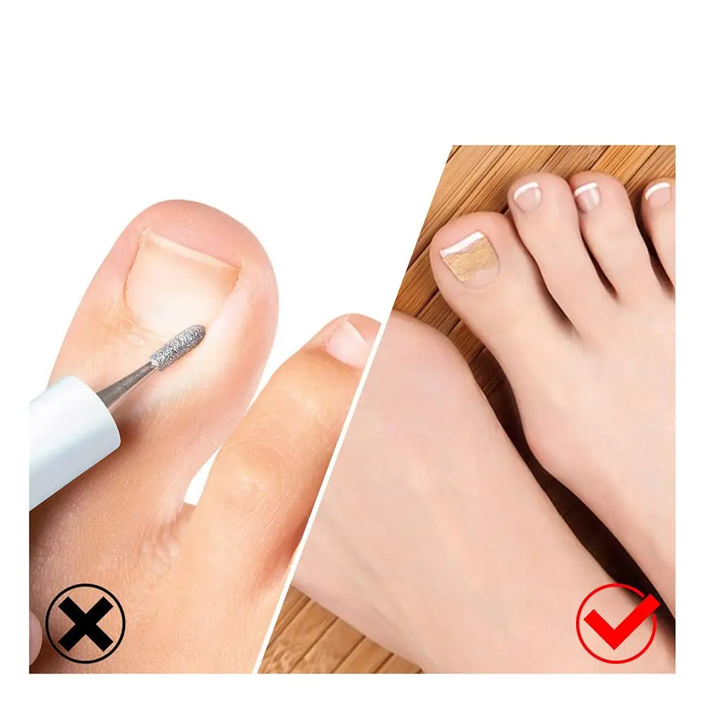 Nail Groove Embedded Nail Corrector Set Of Tools