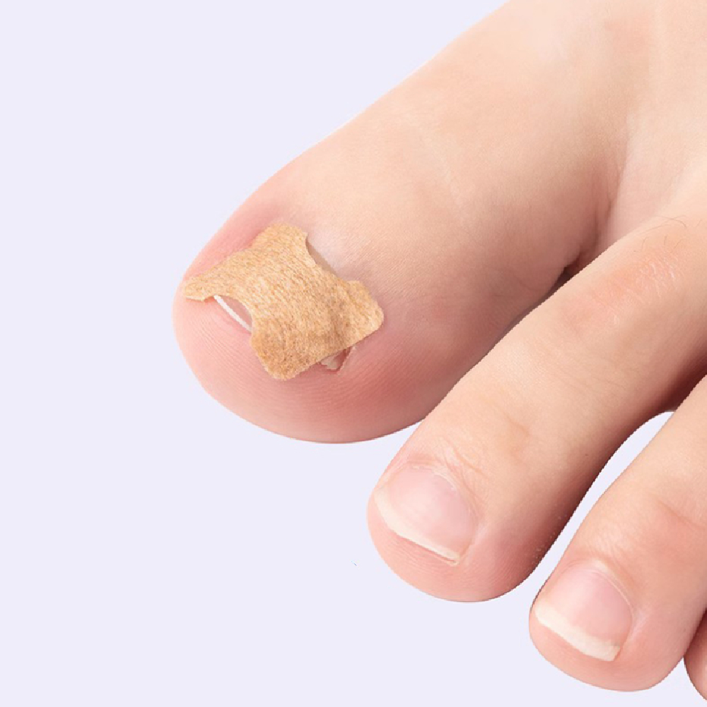 Toe Glue-free Toenail Straightening Sticker