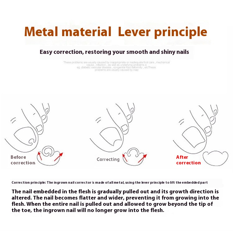 Nail Groove Embedded Nail Corrector Set Of Tools 5