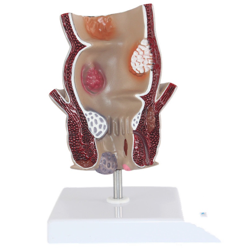 Teaching Simulation Pathological Model Of The Human Colon