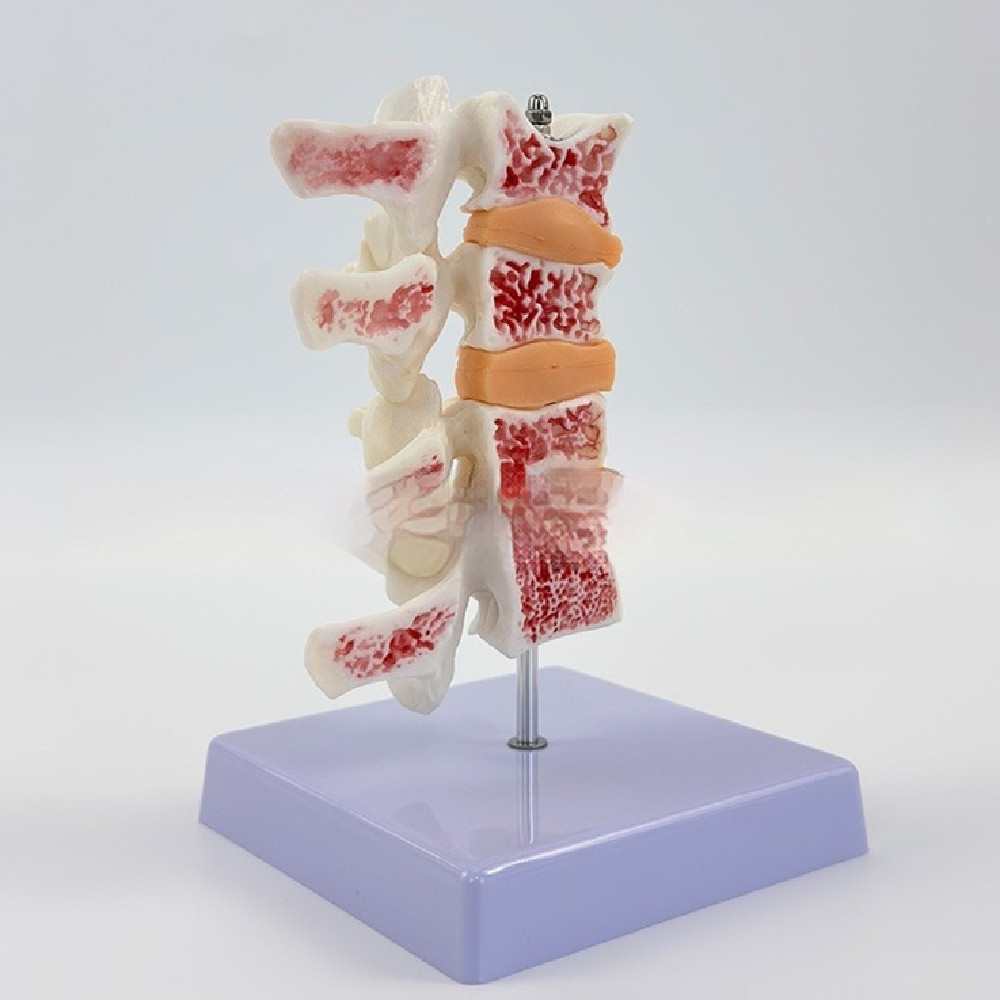 Osteoporosis Human Spine Model Set