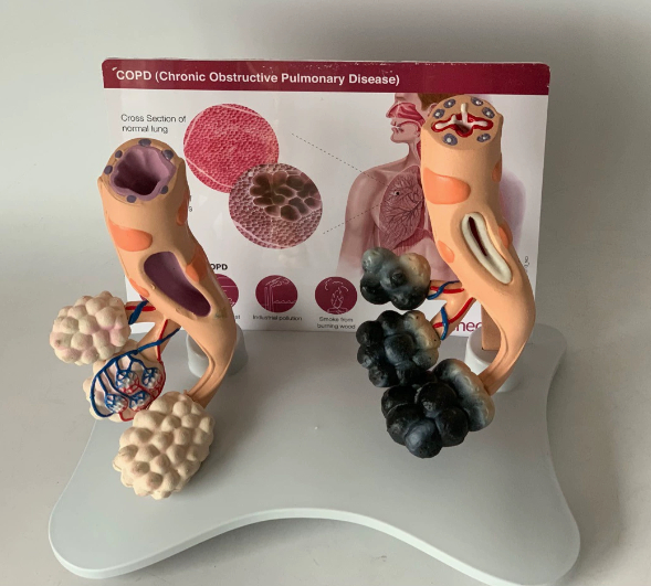 Human Smoking Health And Pathological Alveolar Comparison Model