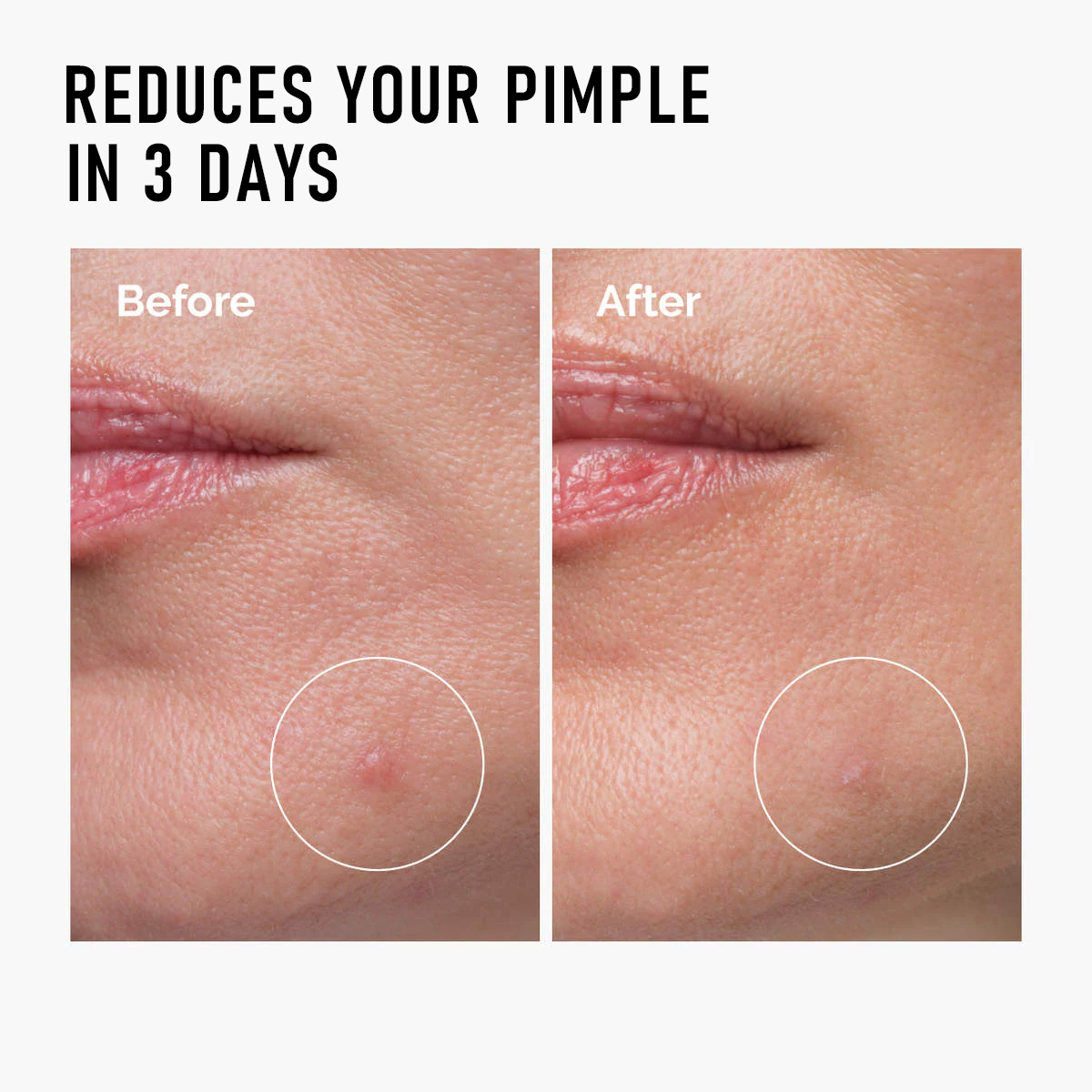 C-S002 Acne Removing image 6